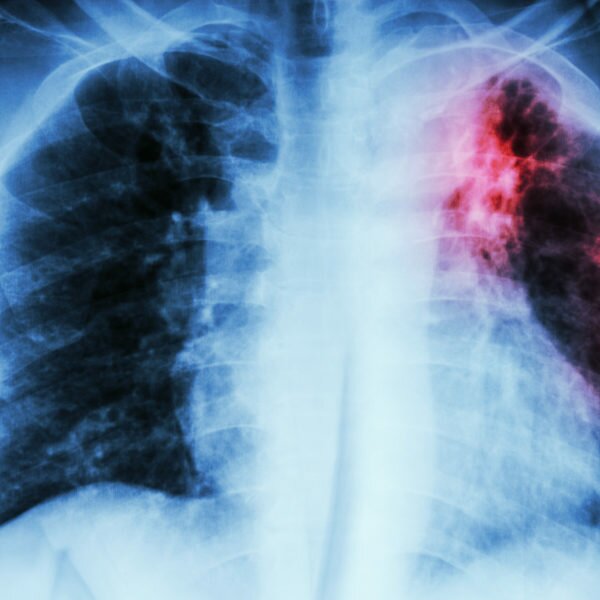 Tuberculosis